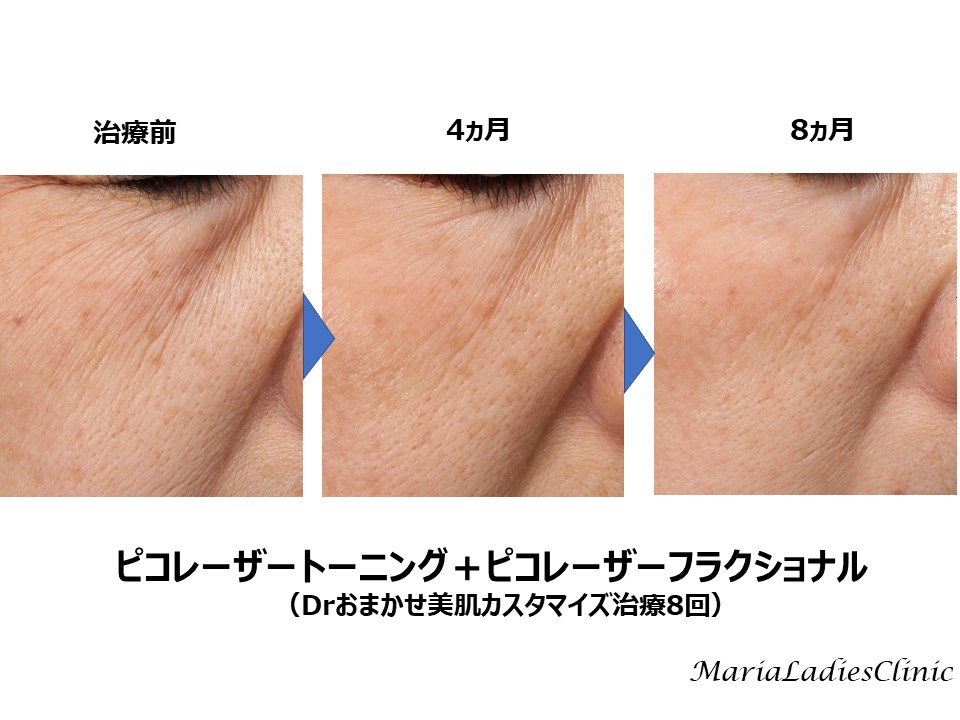 美肌カスタマイズ治療とは マリアレディースクリニック