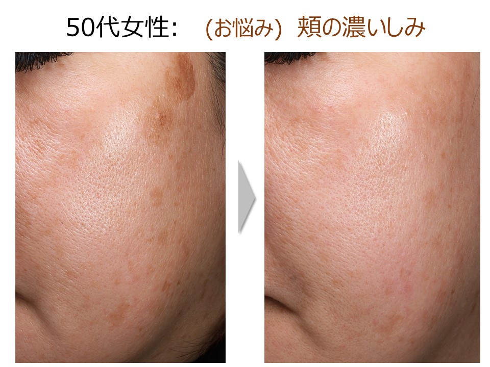 ピコセカンドレーザー ピコレーザー マリアレディースクリニック